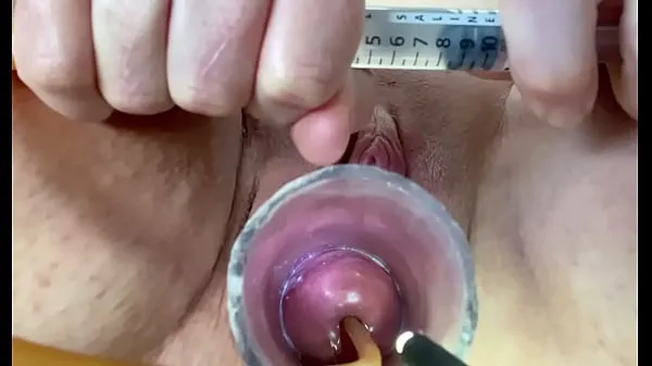 HD Extreme w inflation of catheter balloon in cervix mega Clips