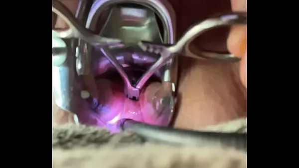 HD Pain opening hemastats while inside cervix mega Clips