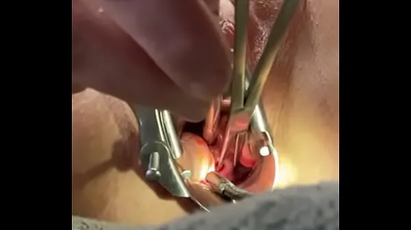 HD Holding cervix w tenaculum while 8mm dilator fucks uterus mega Clips